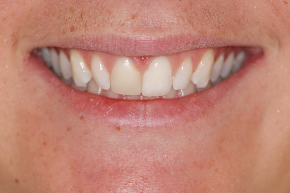 Georgetown Cosmetic Dentistry Before and After 2