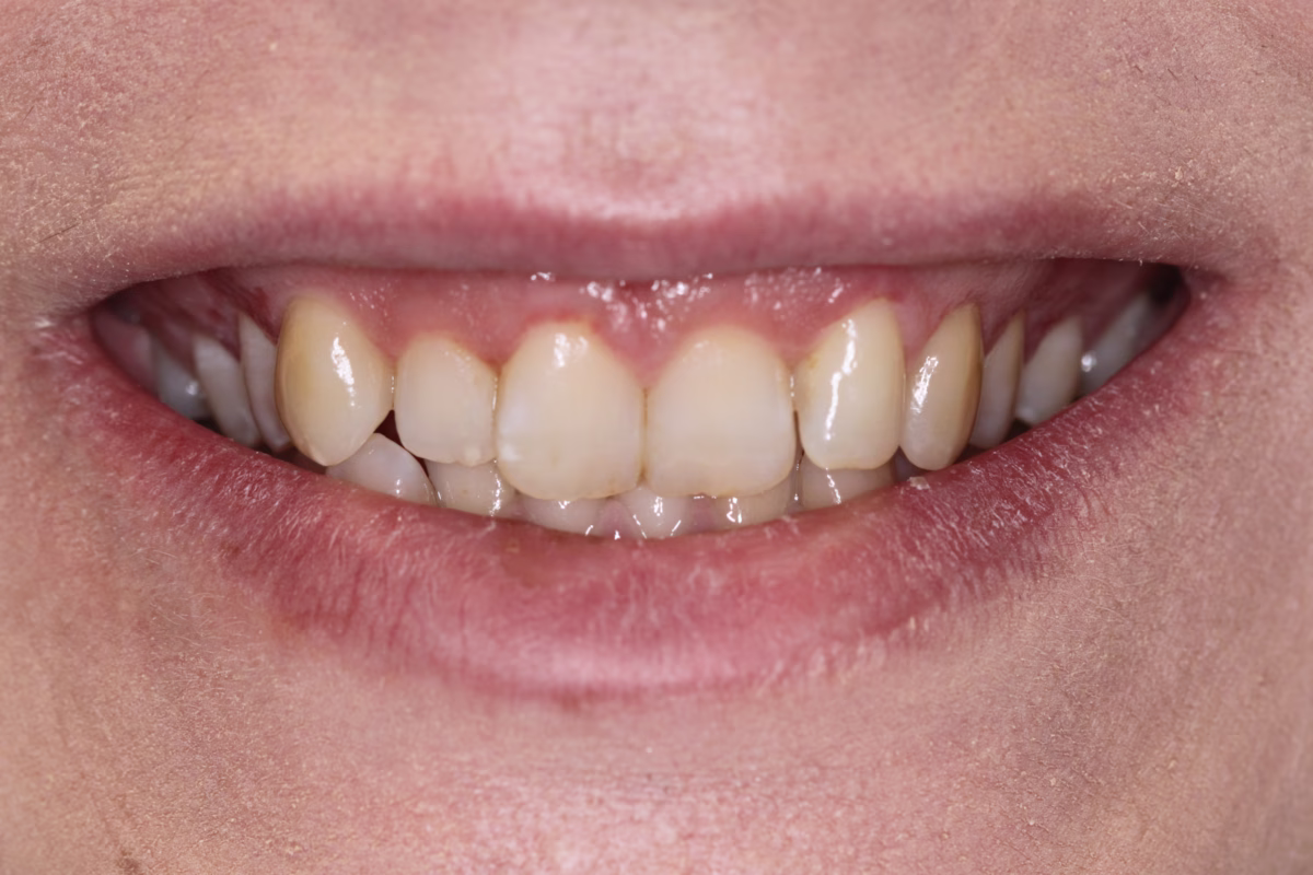 Georgetown Cosmetic Dentistry Before and After 3