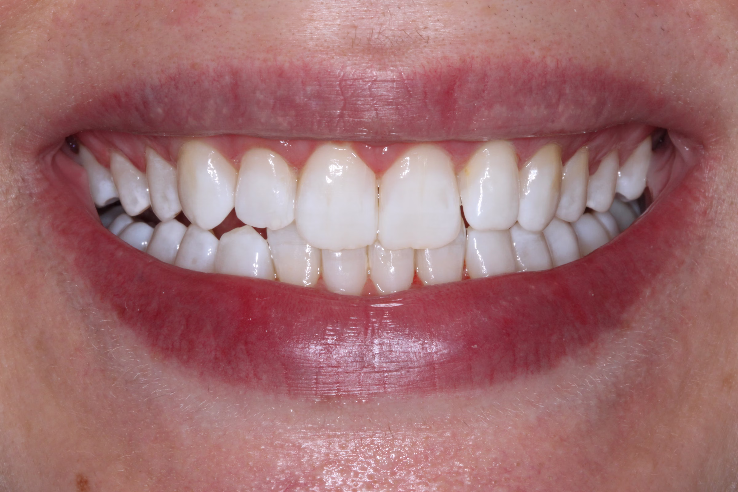 Georgetown Cosmetic Dentistry Before and After 4