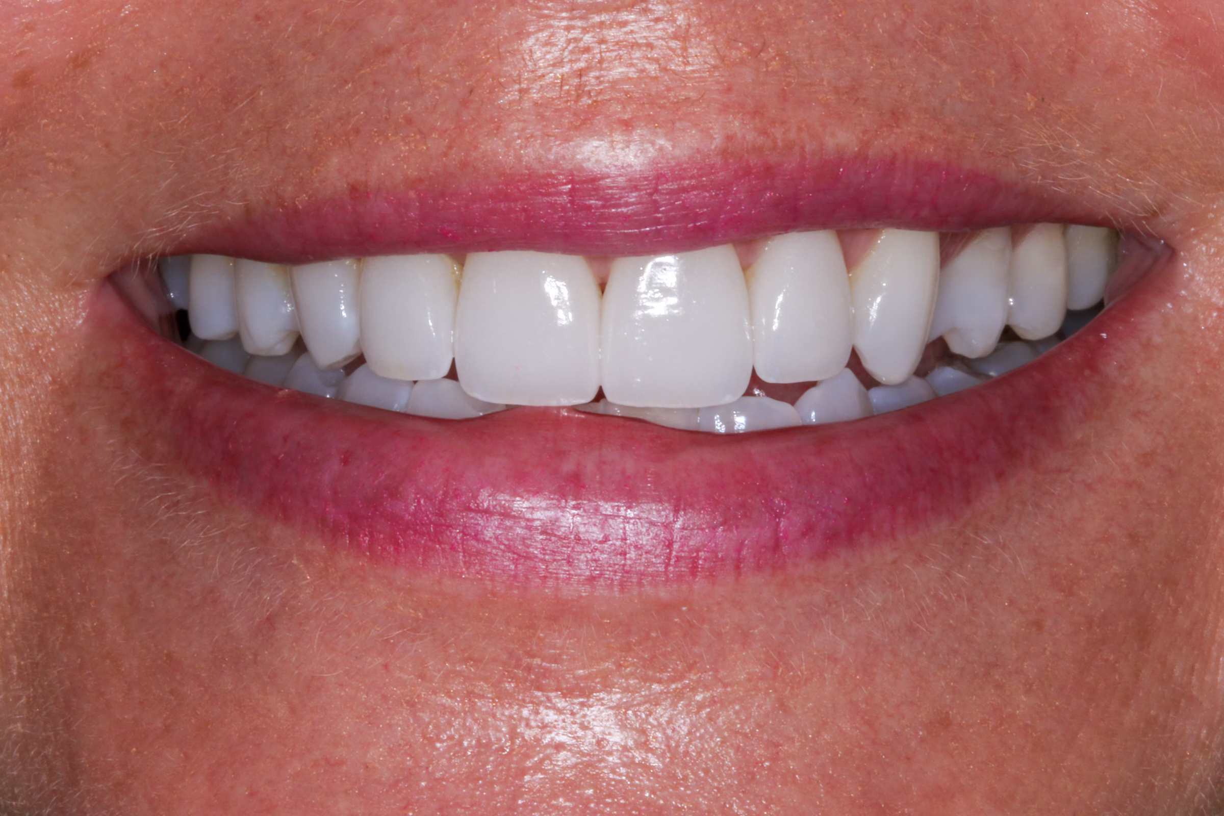 Georgetown Cosmetic Dentistry Before and After 5