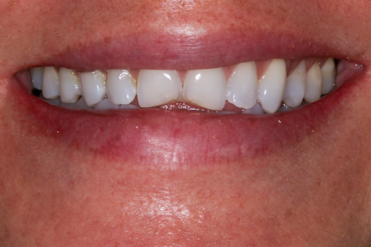 Georgetown Cosmetic Dentistry Before and After 6