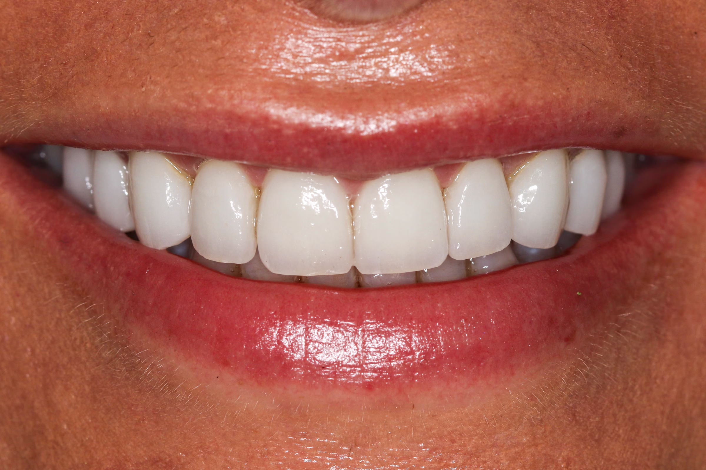 Georgetown Cosmetic Dentistry Before and After 7