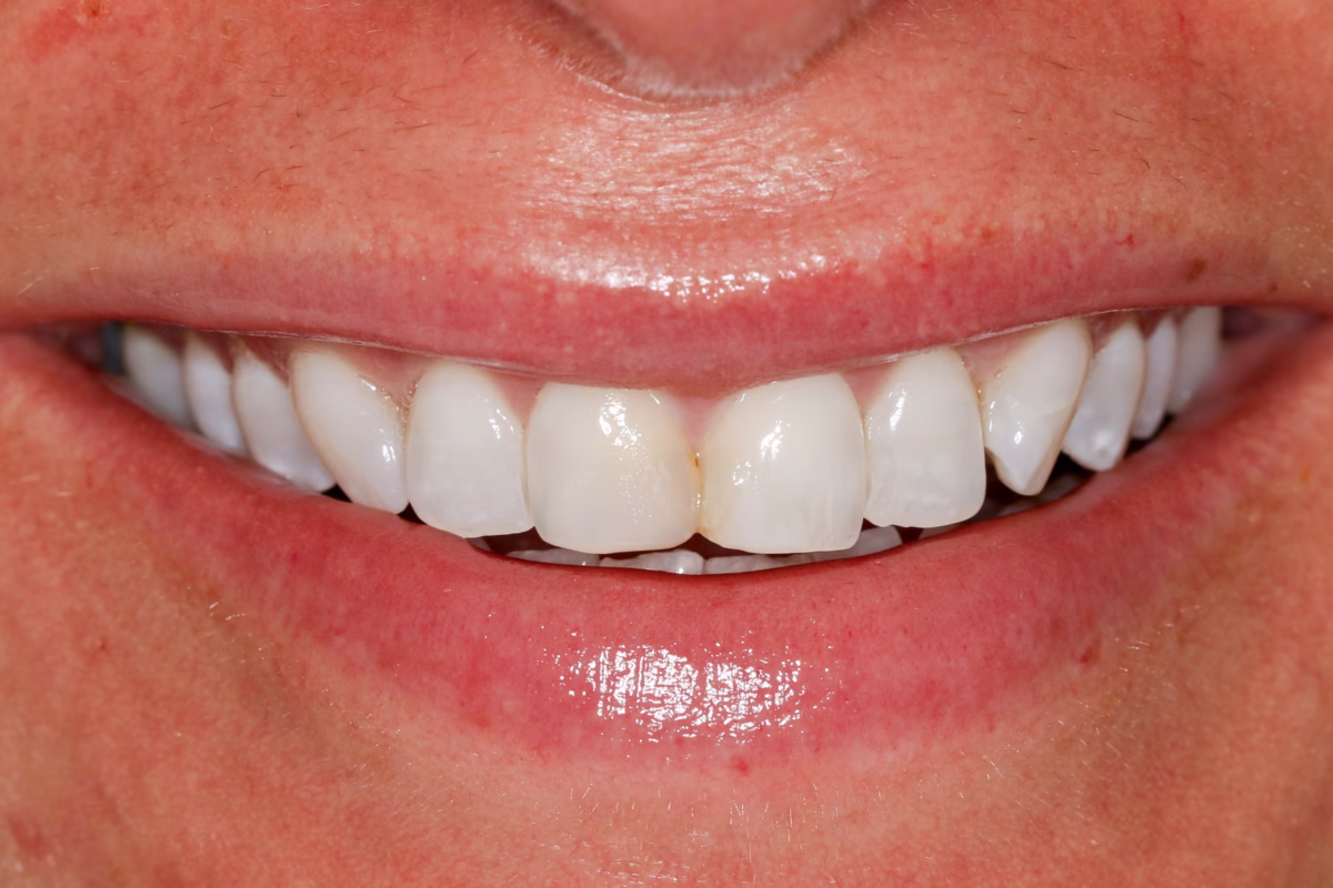 Georgetown Cosmetic Dentistry Before and After 8