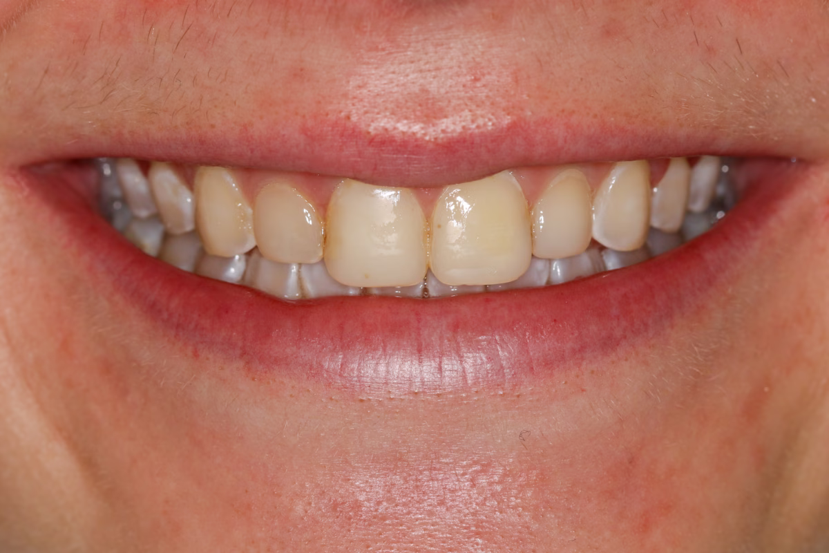 Georgetown Cosmetic Dentistry Before and After 53