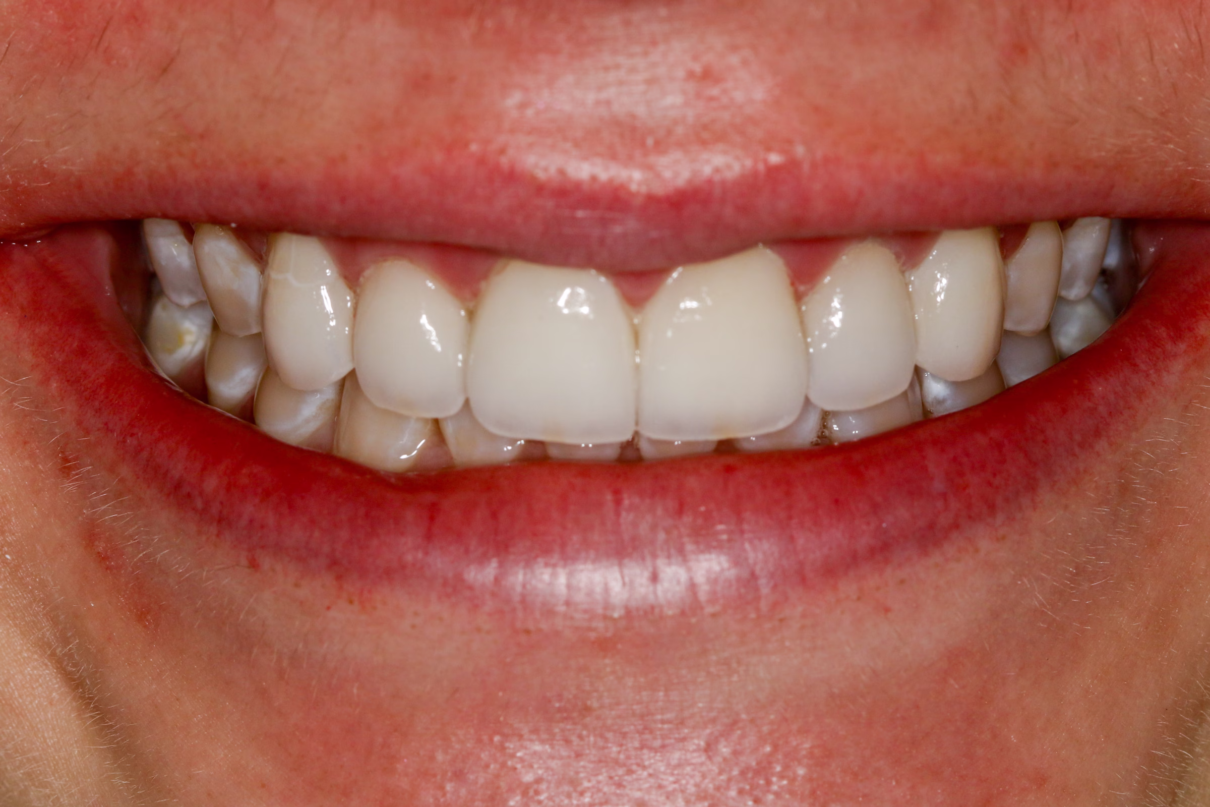 Georgetown Cosmetic Dentistry Before and After 54
