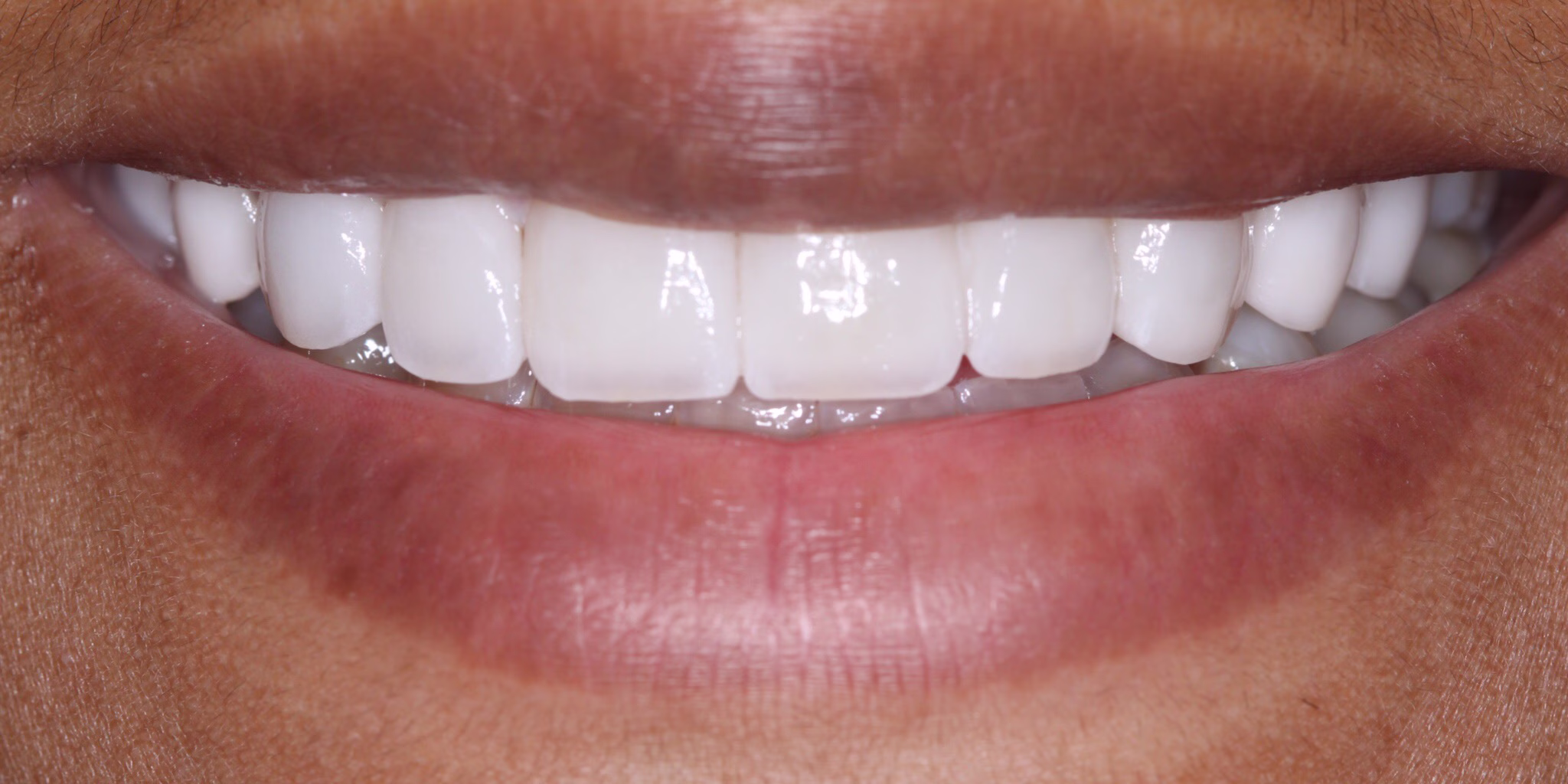janae veneers after smile makeover georgetown dc - Janae's Smile Story After photo of a patient with new porcelain veneers from Dr Roshan at Georgetown Cosmetic Dentistry in Washington DC.