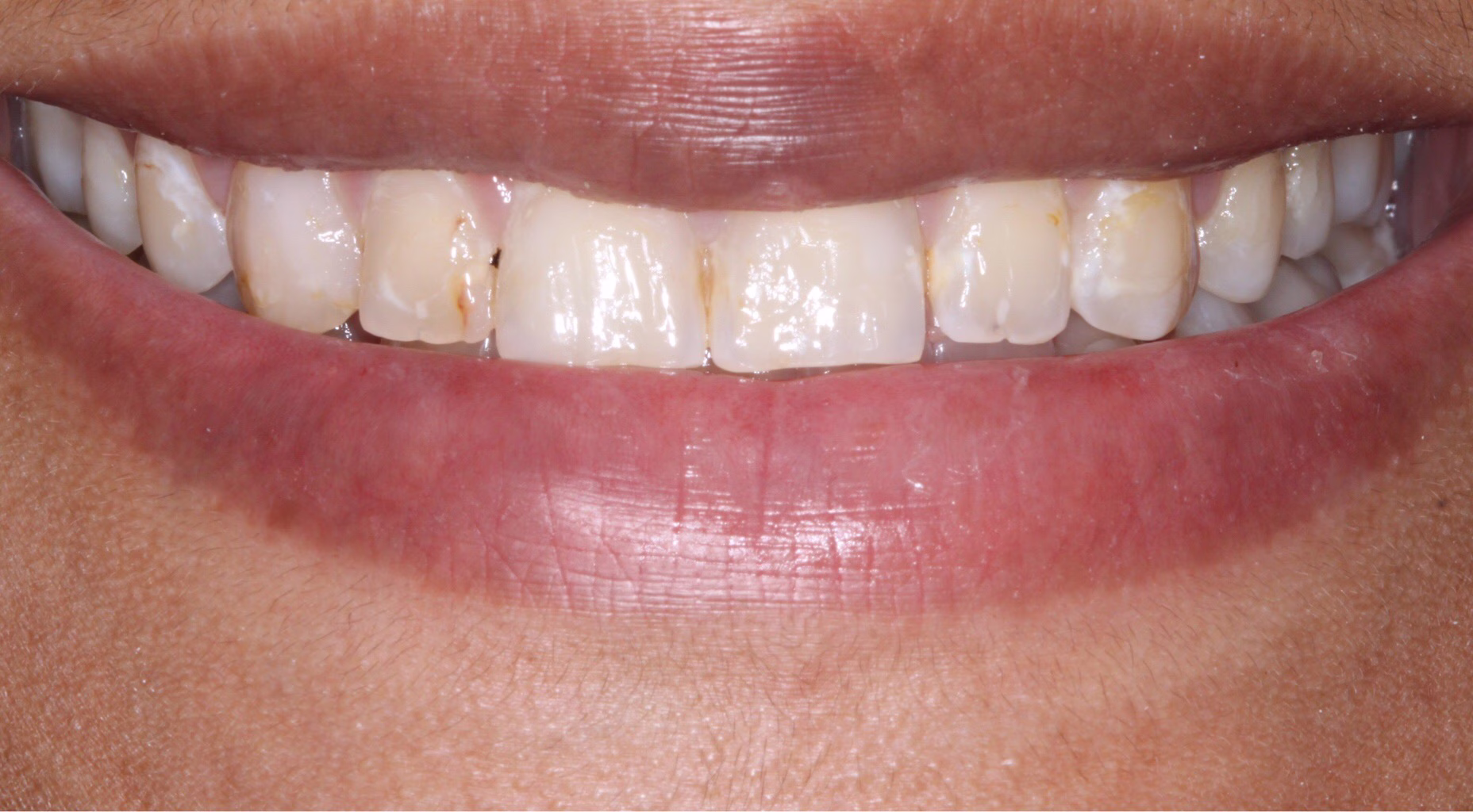 janae veneers before smile makeover georgetown dc - Janae's Smile Story Before photo of a patient with worn and discolored teeth prior to porcelain veneers treatment at Georgetown Cosmetic Dentistry in Washington DC.